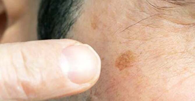  Skin Cancer vs. Age Spots – When Should You Be Concerned?